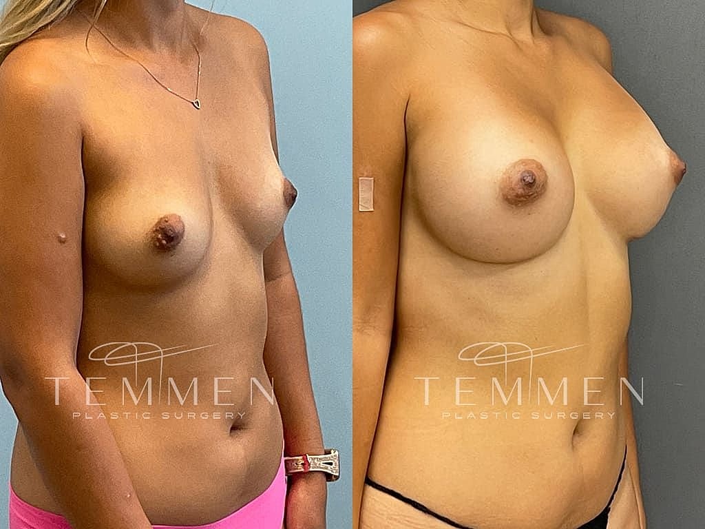Breast augmentation before and after comparison.