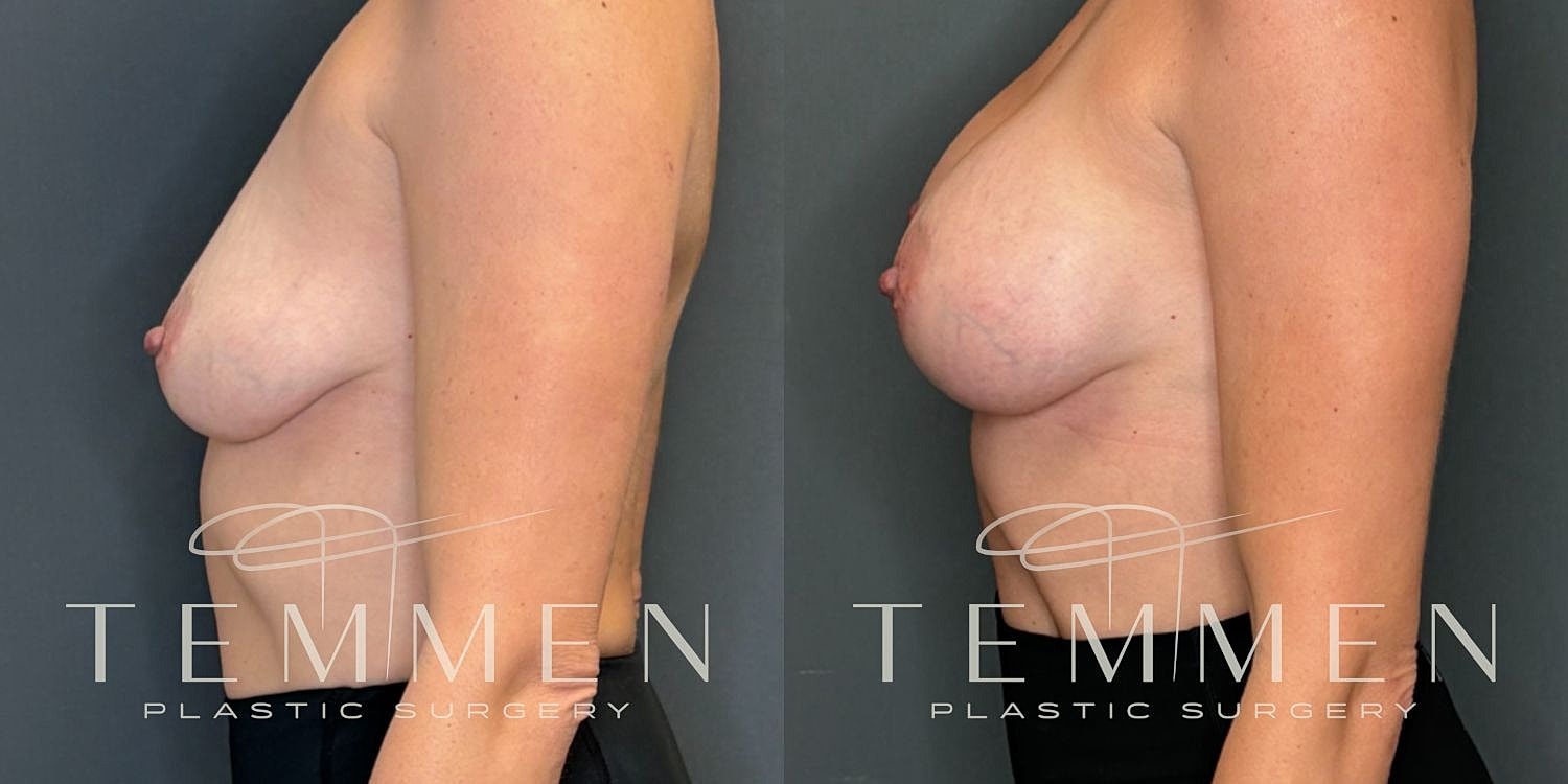 Small Breast Augmentation Before & After