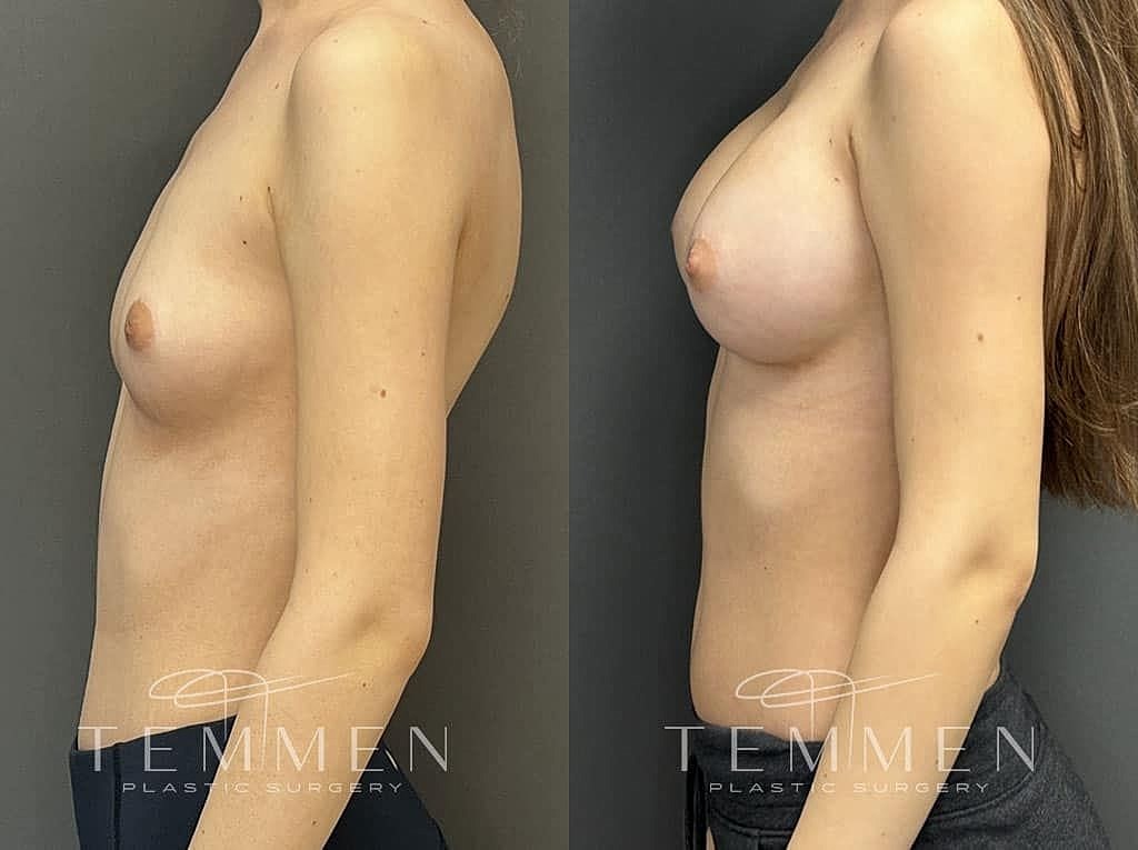 Before and after breast enhancement photos
