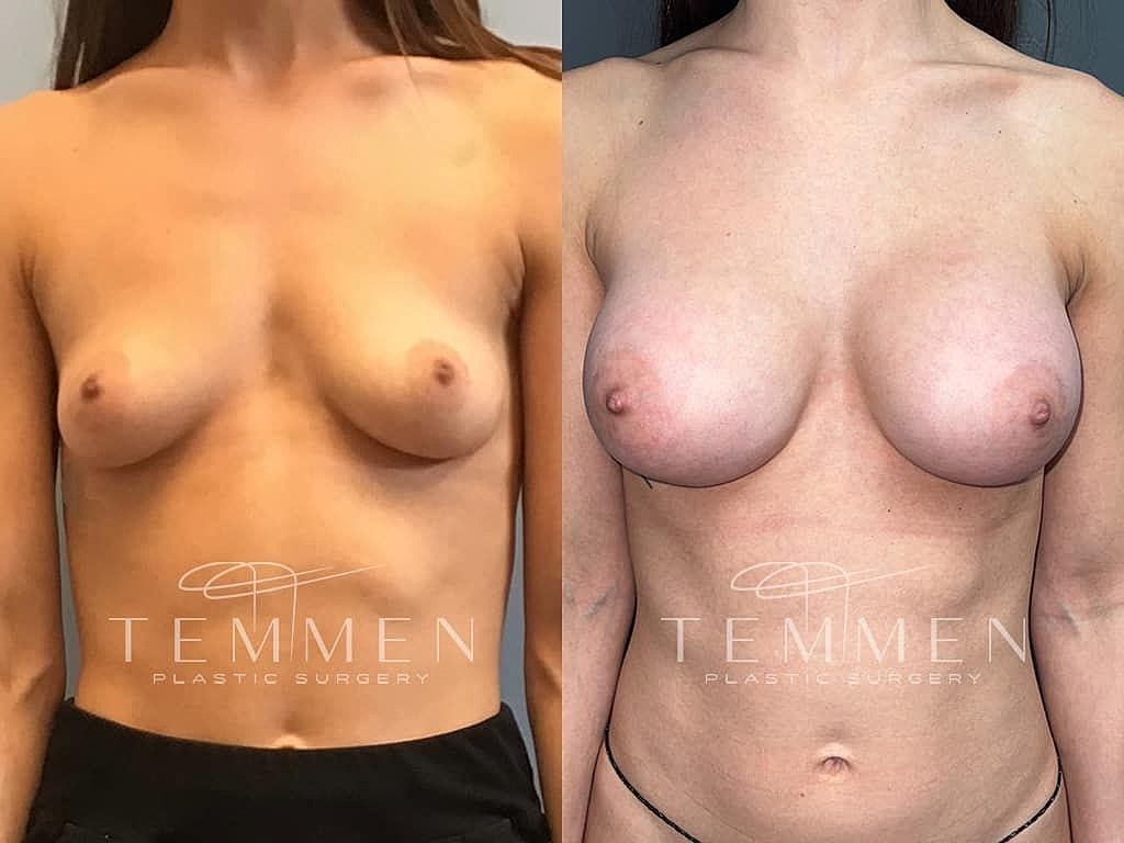 Before and after breast augmentation images