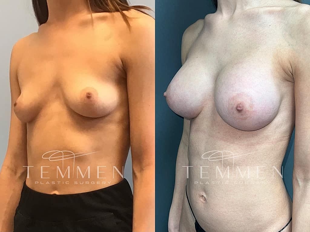 Before and after breast augmentation photos.