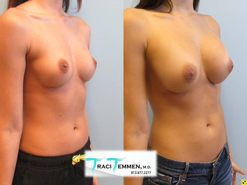 Before and after breast augmentation comparison image.