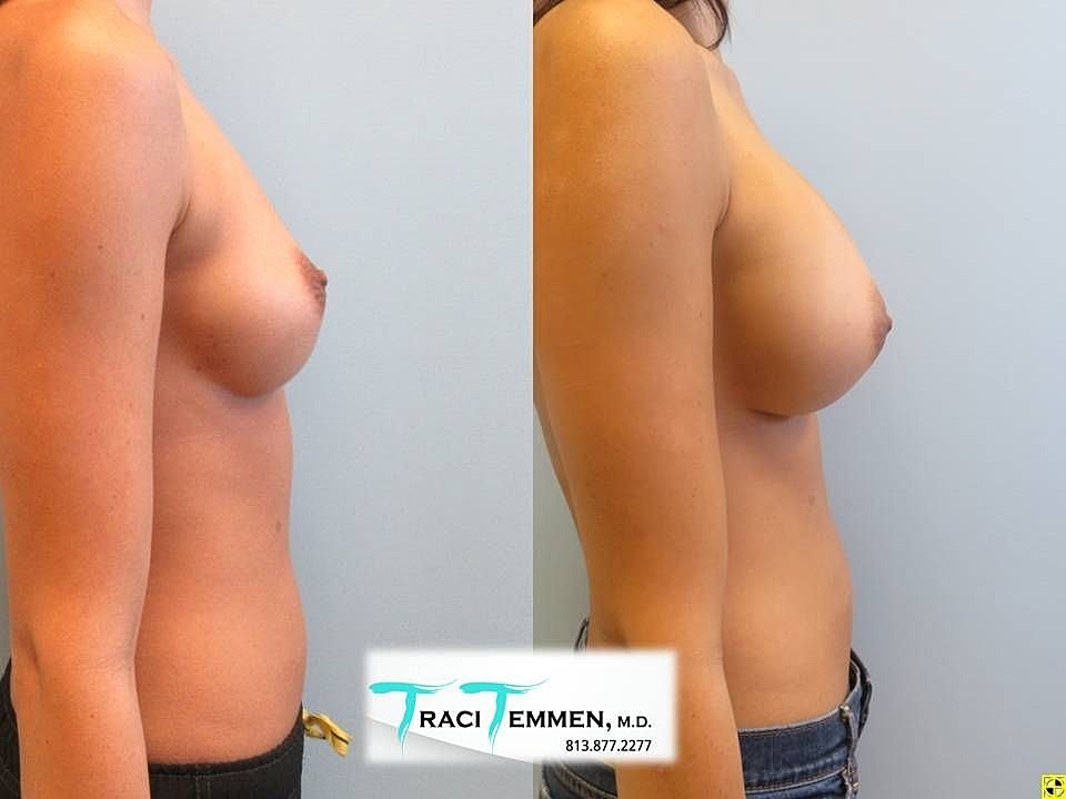 Before and after breast augmentation comparison side view.