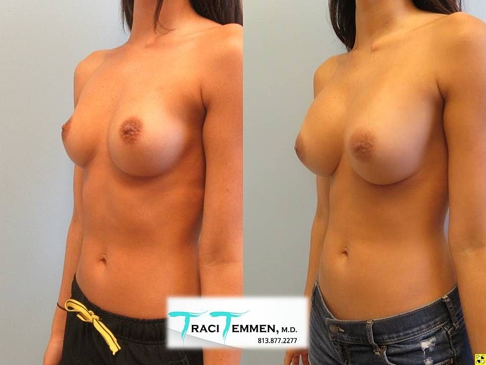Before and after breast augmentation comparison photo.