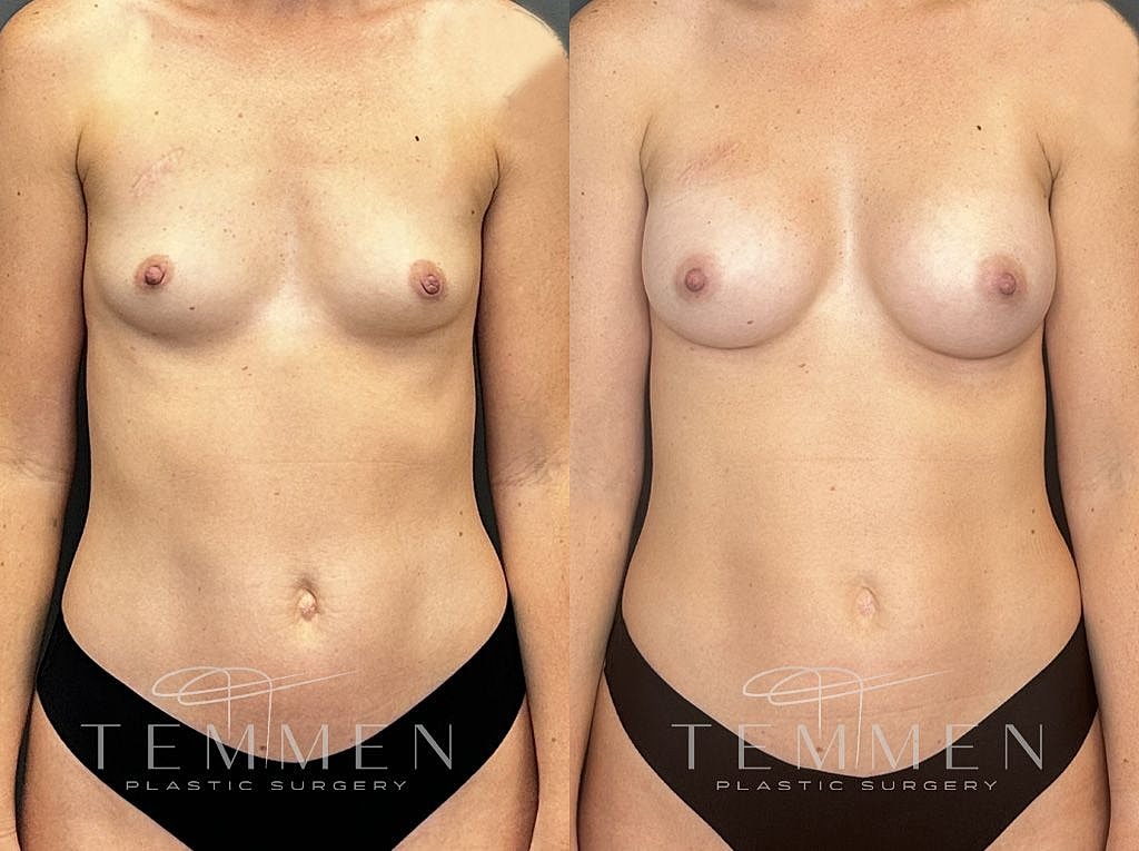 Before and after breast enhancement comparison image