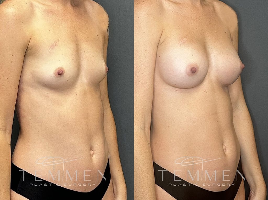 Before and after breast augmentation results side-by-side.