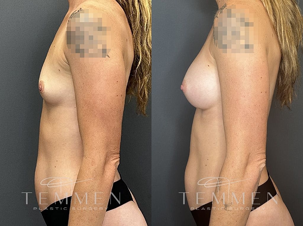 Before and after breast enhancement surgery comparison.