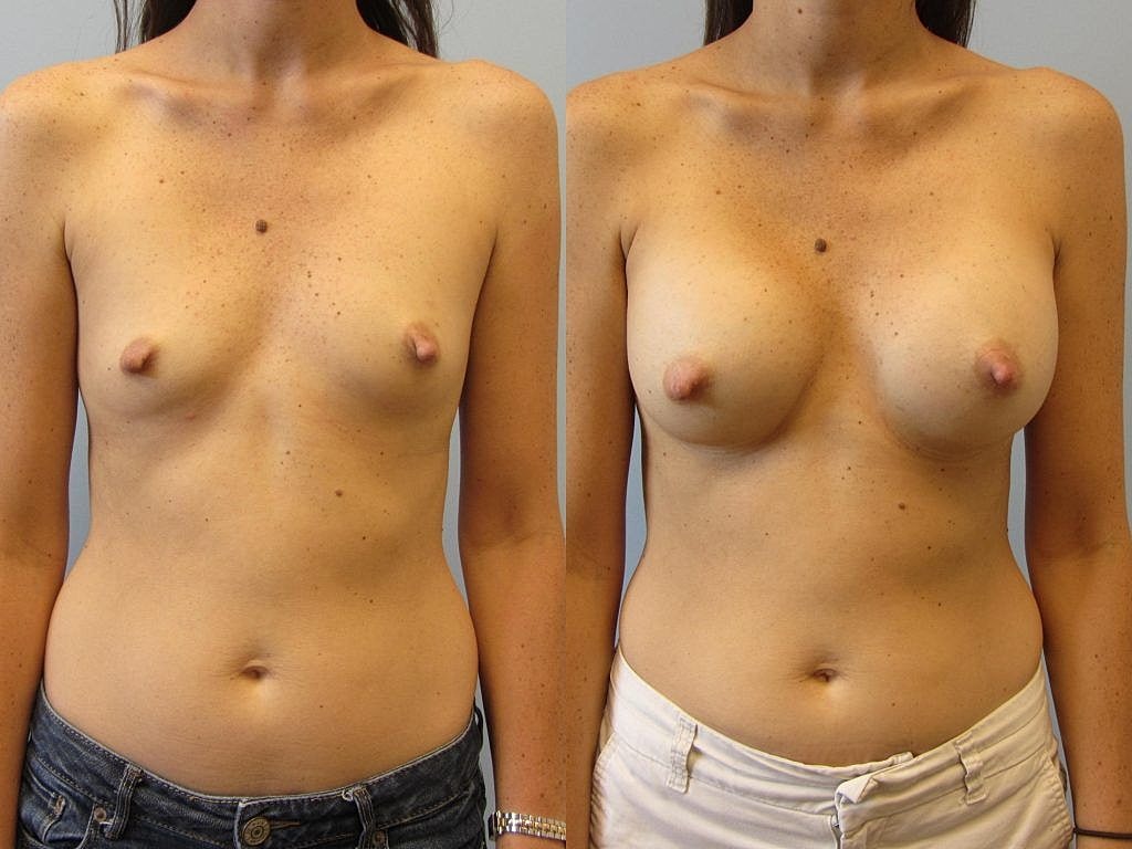 Before and after breast augmentation results comparison.