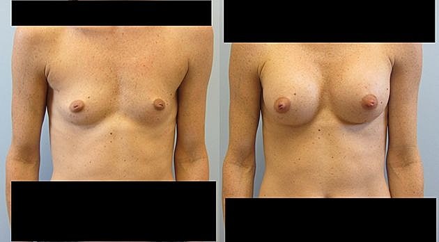 Breast augmentation before and after comparison.