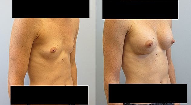 Before and after aesthetic procedure comparison.