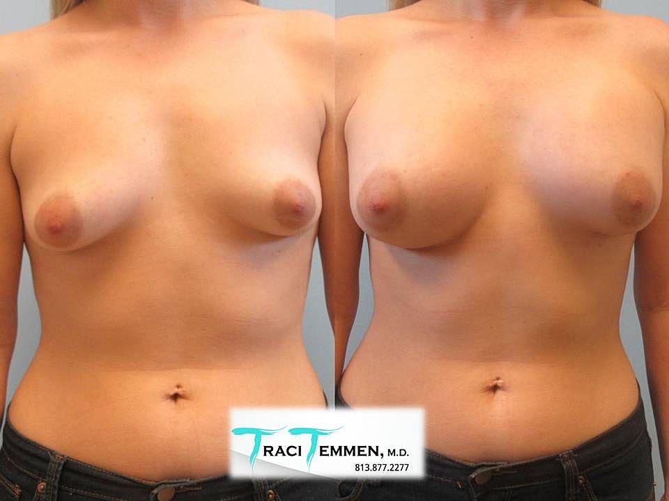 Before and after breast enhancement procedure comparison.