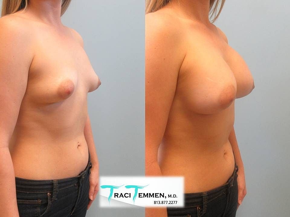 Before and after breast enhancement comparison.