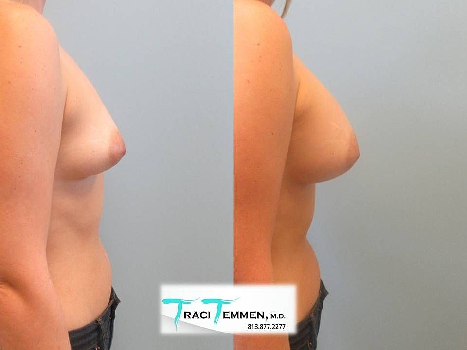 Before and after breast enhancement comparison.