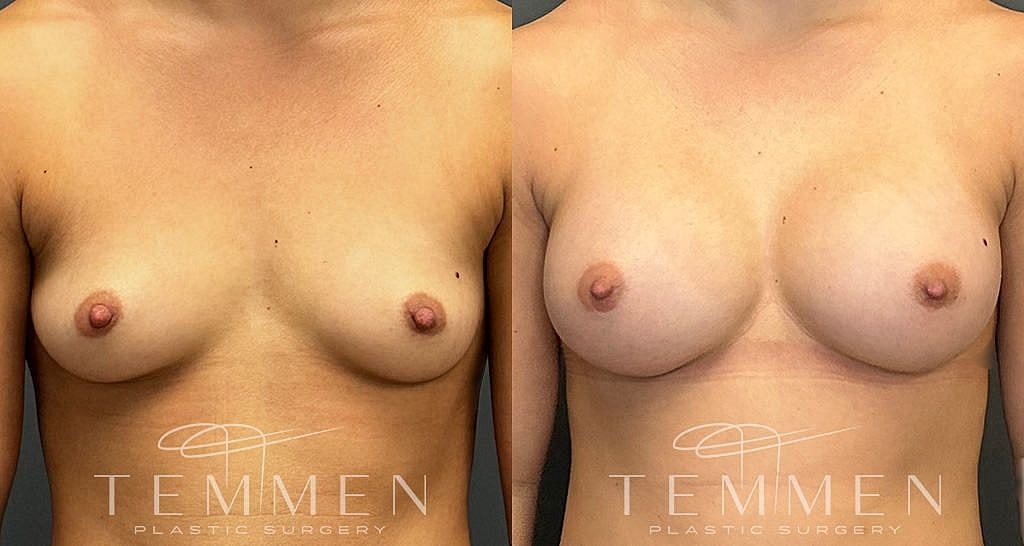 Before and after breast augmentation results comparison.