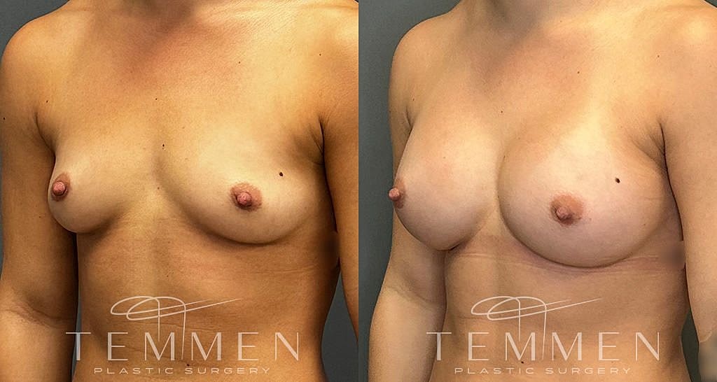 Before and after breast surgery comparison image.