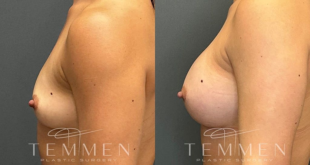 Before and after breast augmentation comparison.