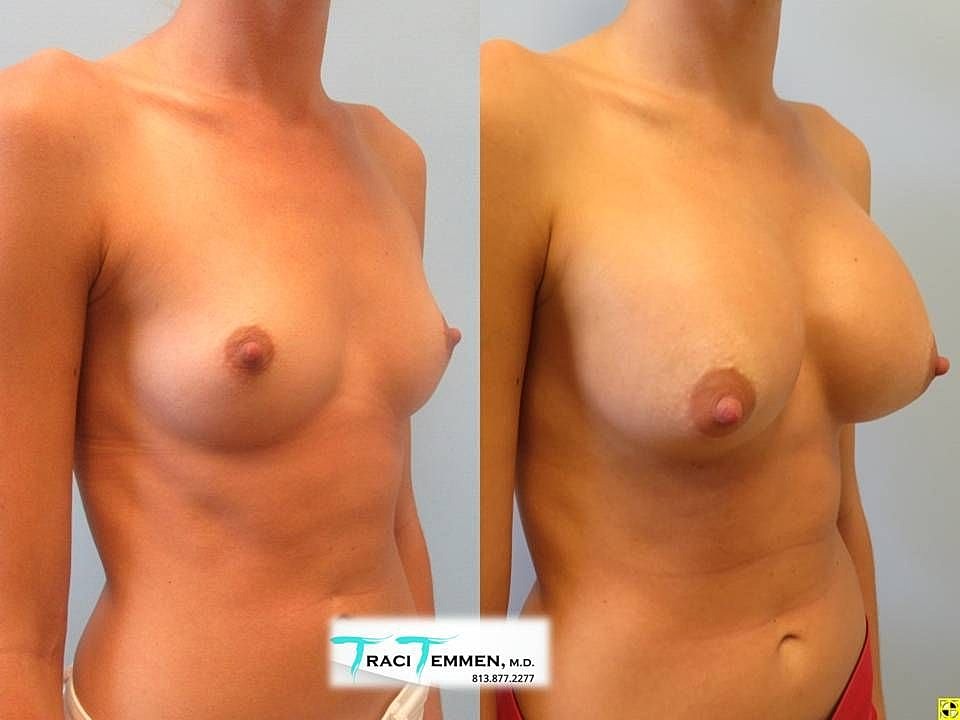 Before and after breast enhancement comparison image.
