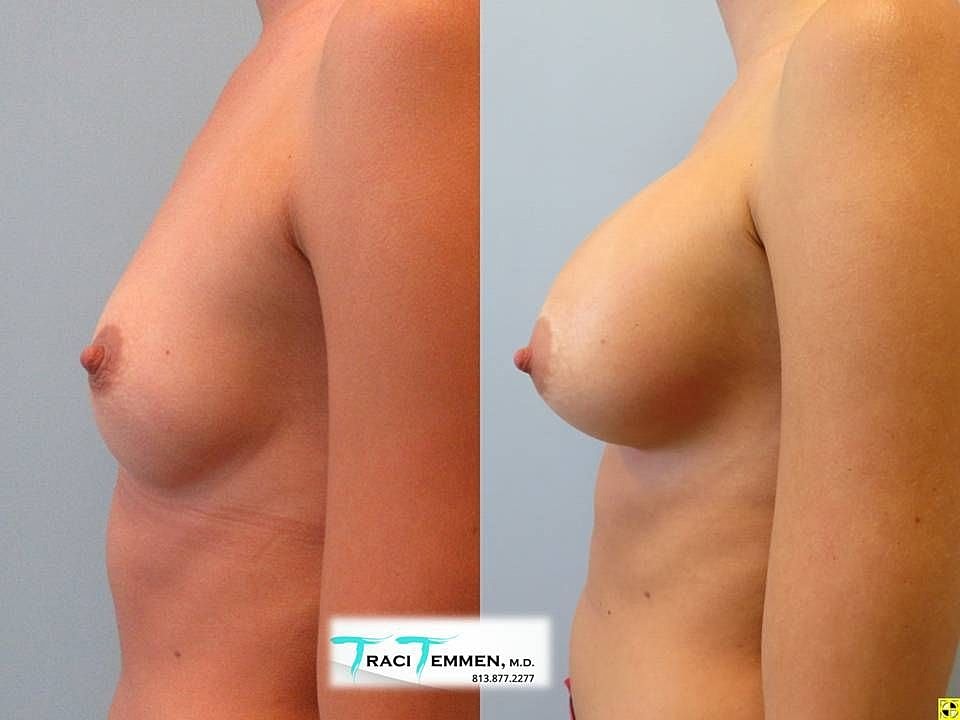 Before and after breast enhancement procedure comparison.