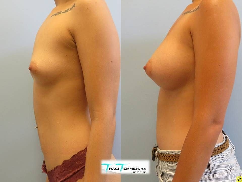Side view before and after cosmetic procedure.
