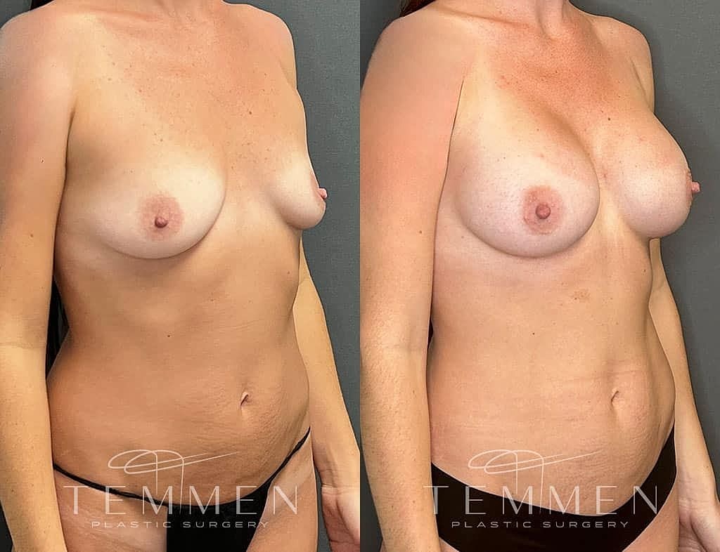 Before and after breast augmentation images comparison.