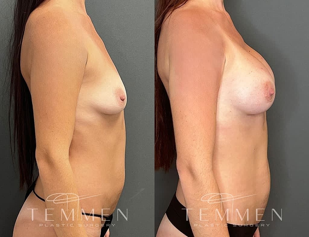 Before and after breast augmentation comparison photo.