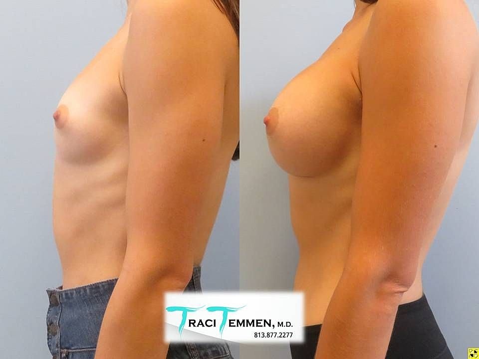 Before and after breast augmentation comparison photo.