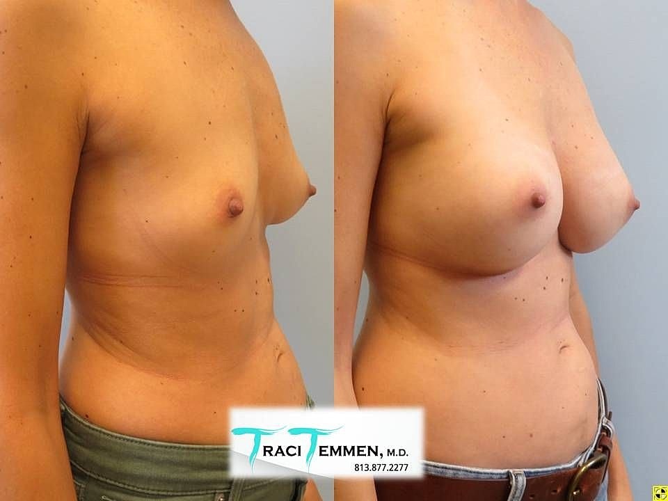 Breast augmentation before and after photos