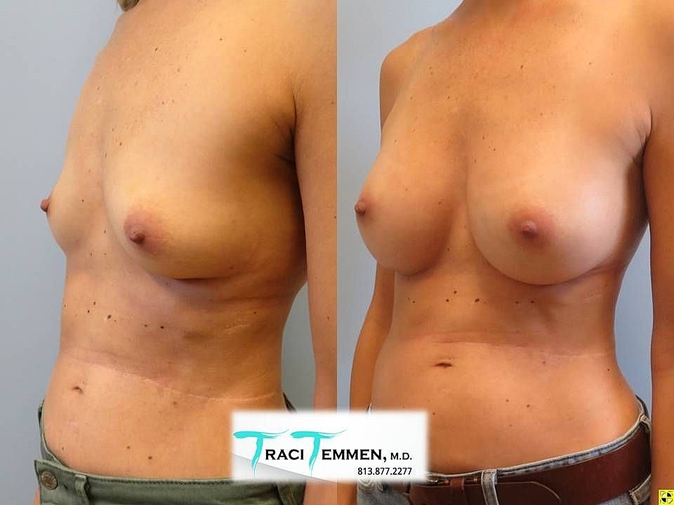Before and after breast augmentation comparison photo.
