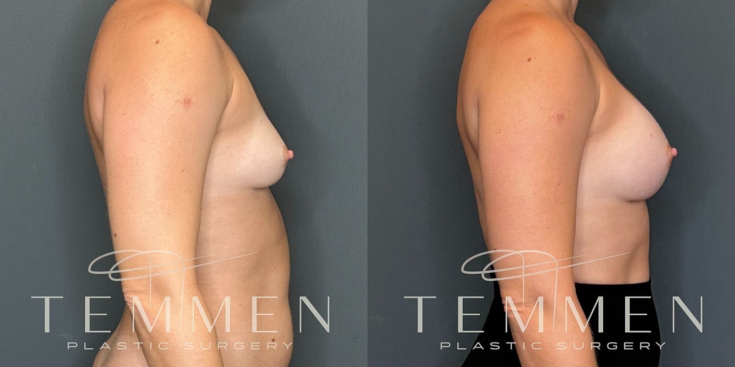 Small Breast Augmentation Before & After