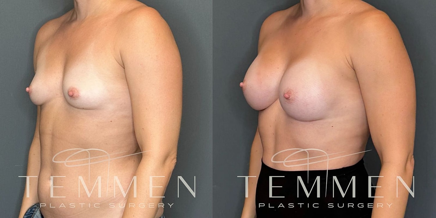Small Breast Augmentation Before & After
