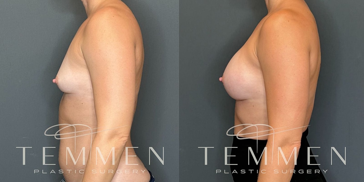 Small Breast Augmentation Before & After
