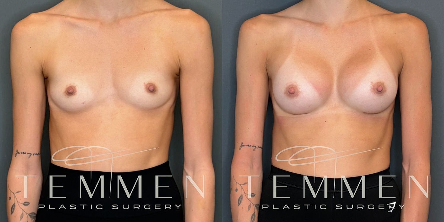 Small Breast Augmentation Before & After