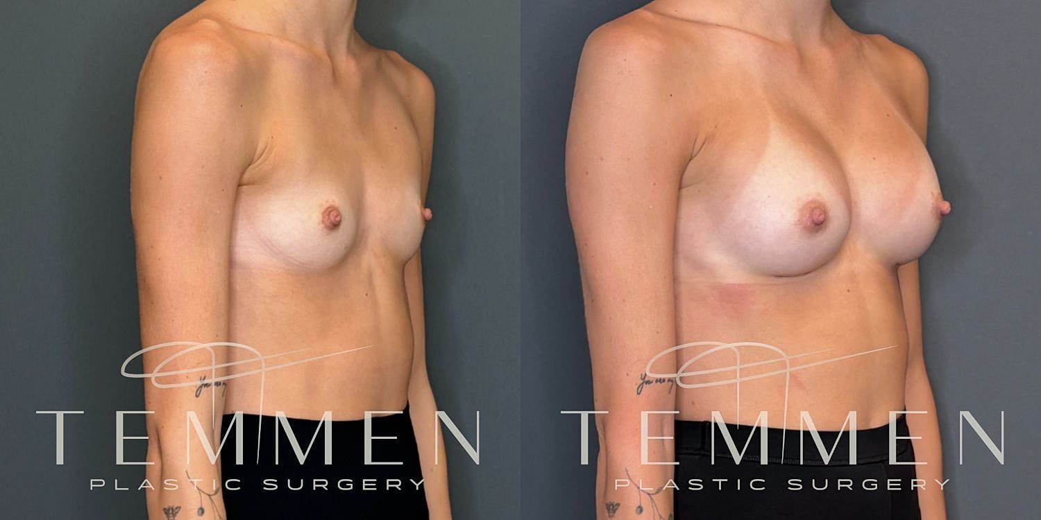 Small Breast Augmentation Before & After