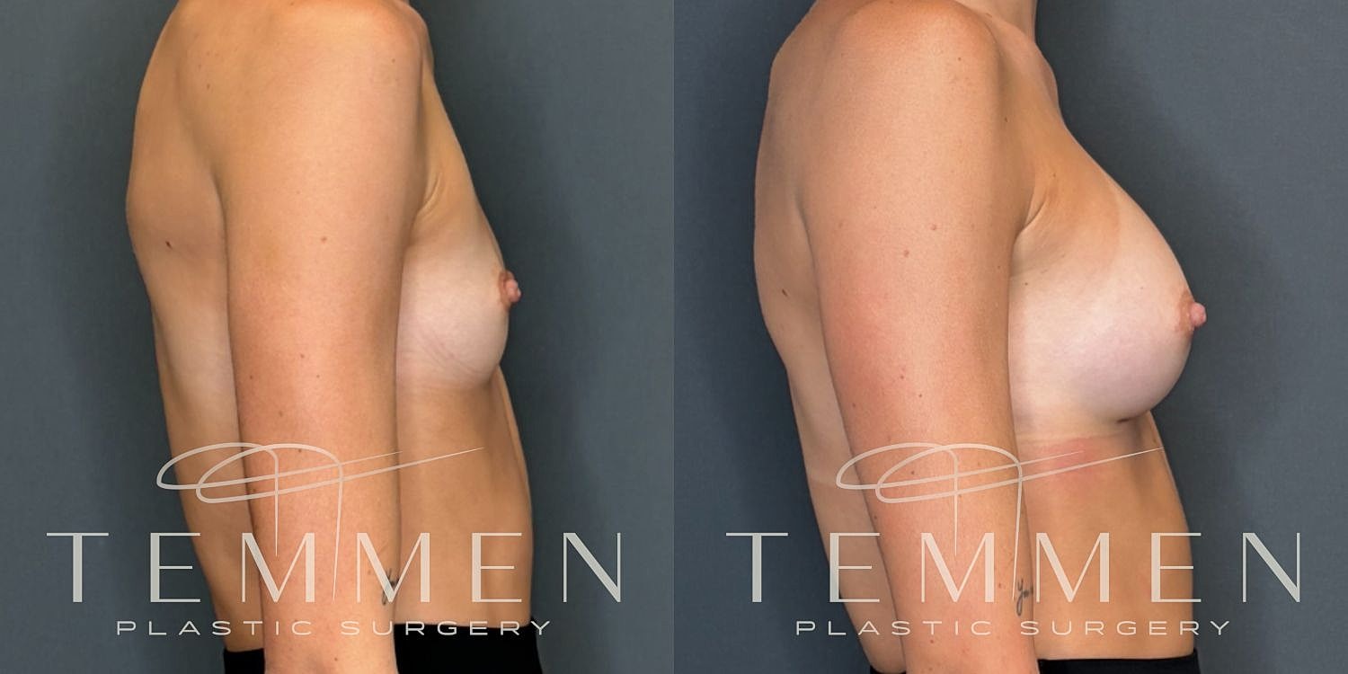 Small Breast Augmentation Before & After