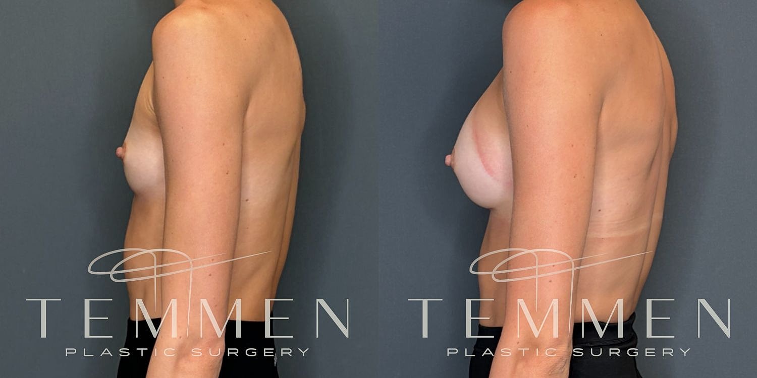 Small Breast Augmentation Before & After