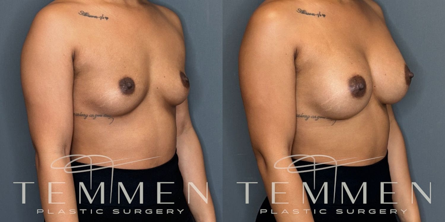Small Breast Augmentation Before & After