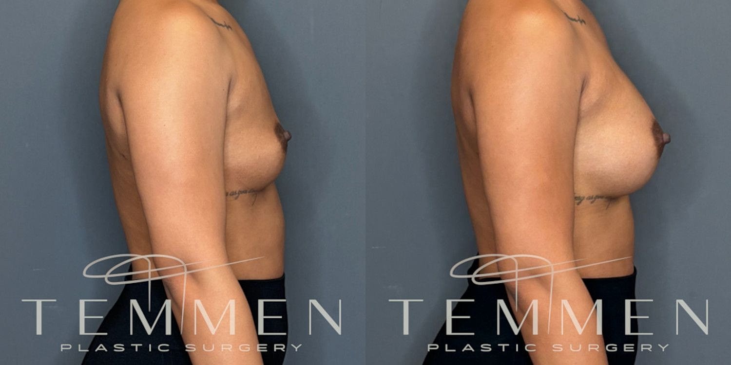 Small Breast Augmentation Before & After