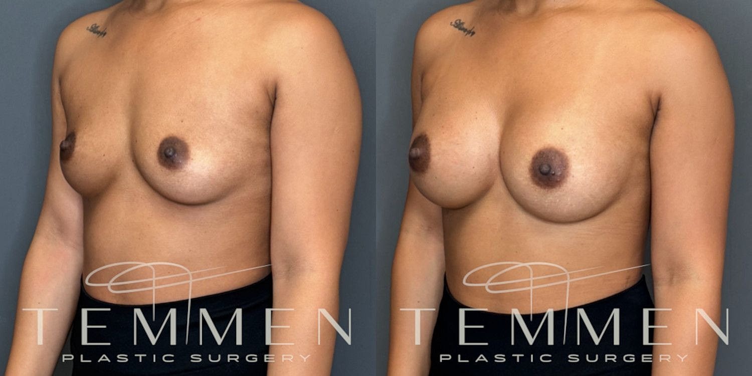 Small Breast Augmentation Before & After