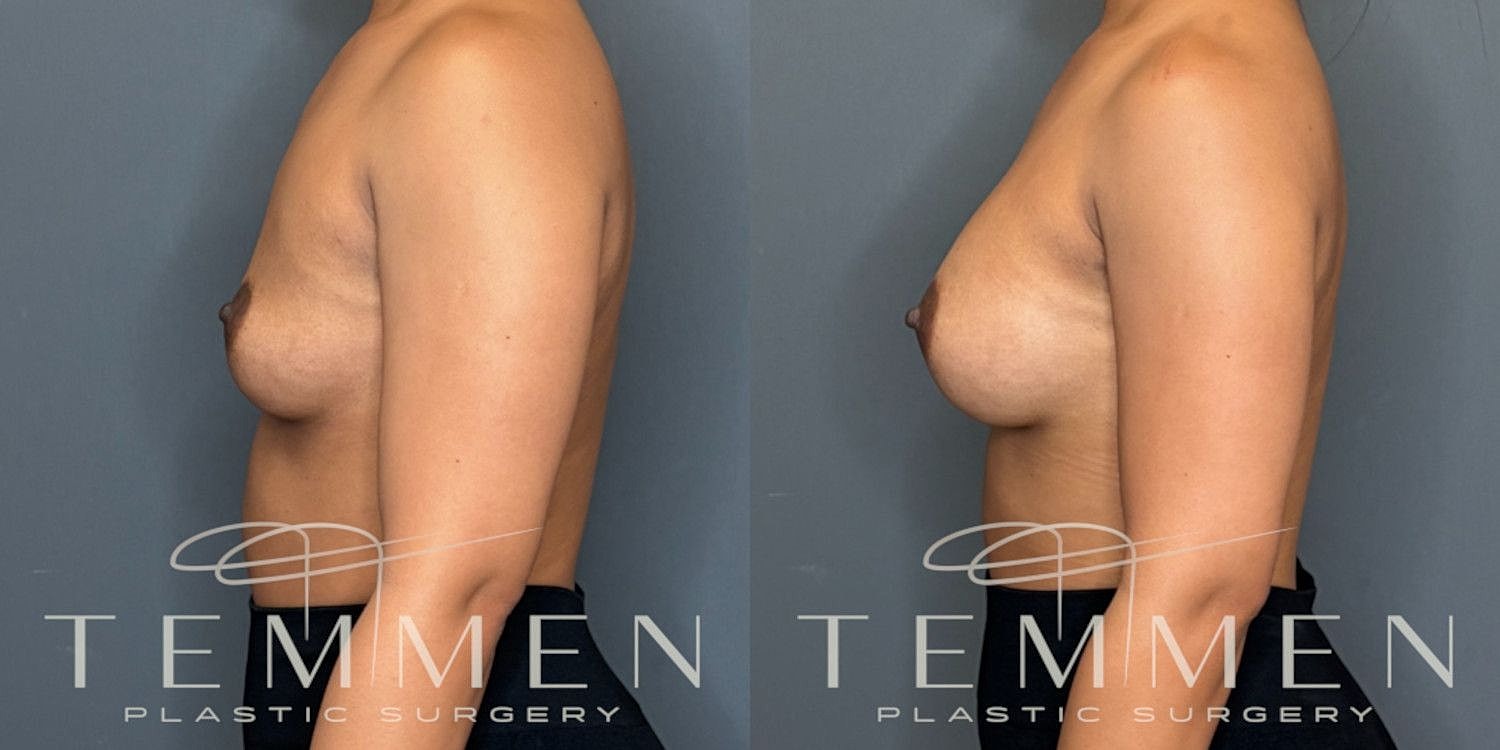 Small Breast Augmentation Before & After