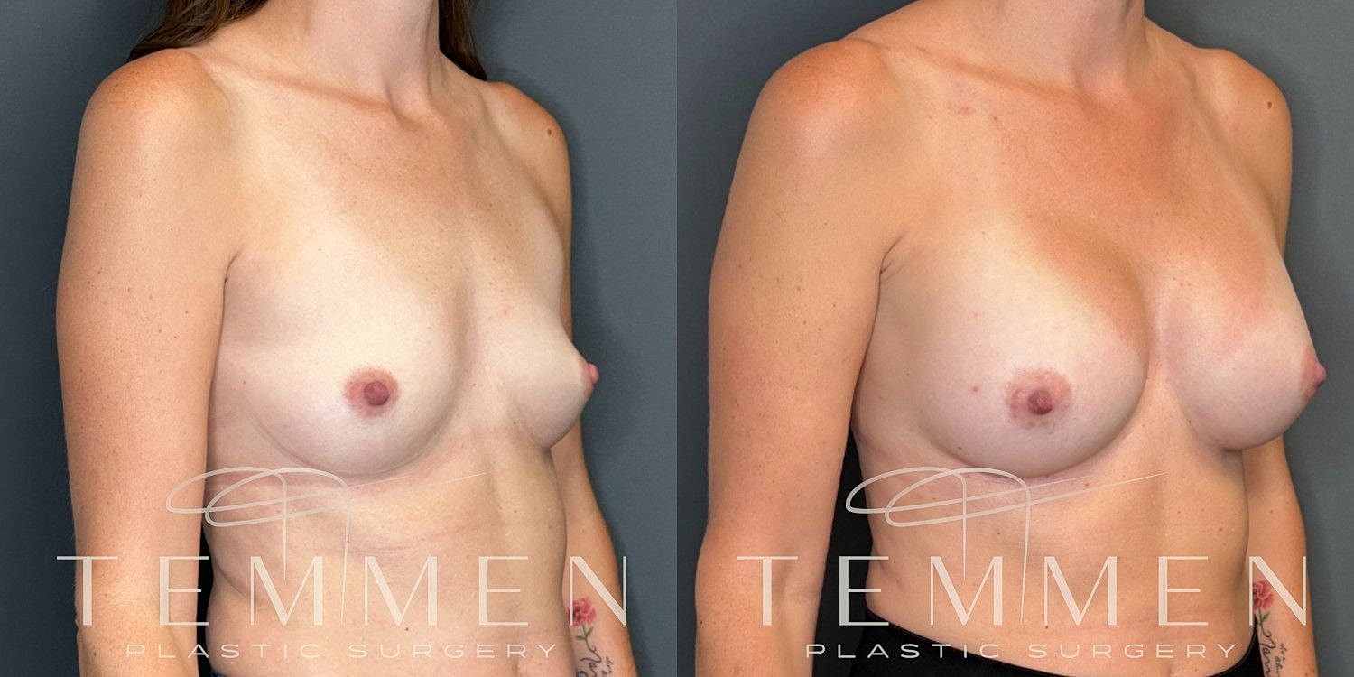 Small Breast Augmentation Before & After