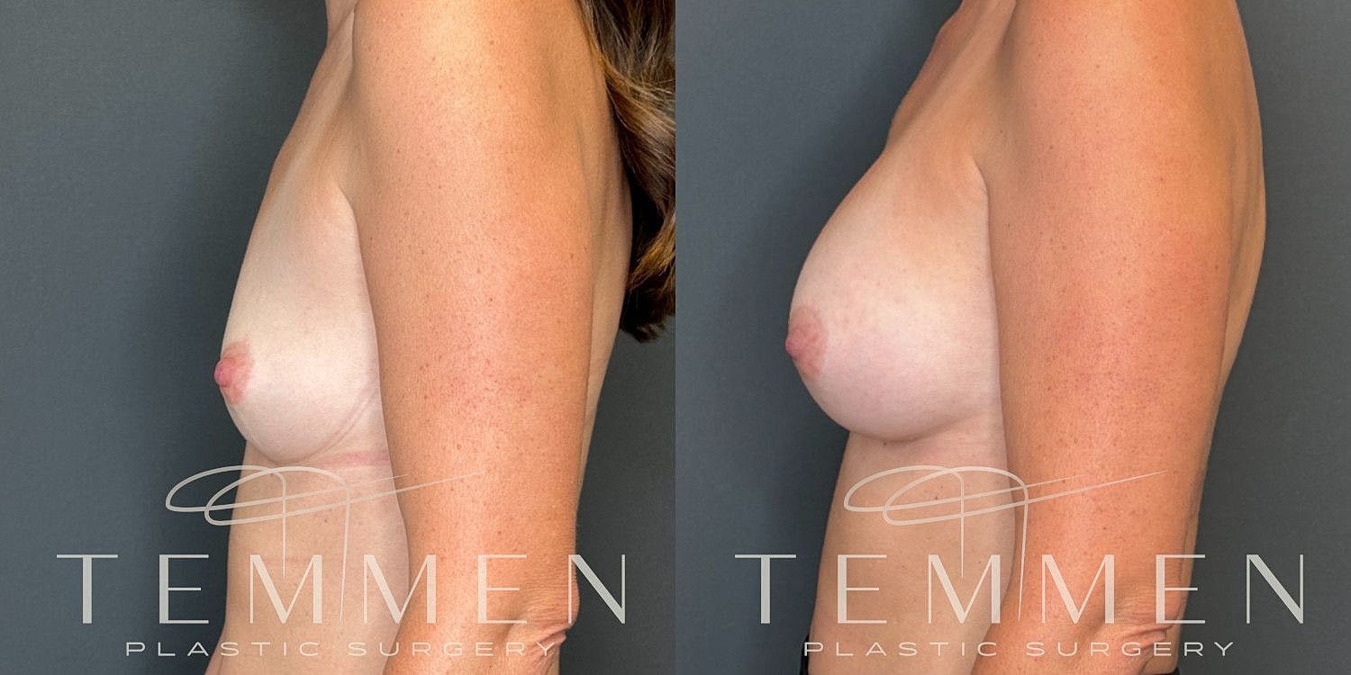 Small Breast Augmentation Before & After