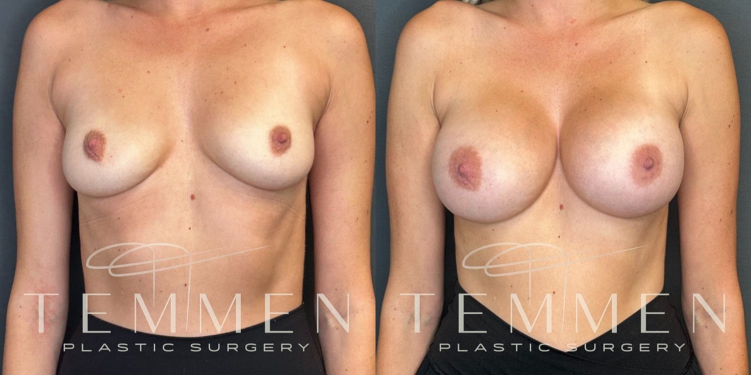 Small Breast Augmentation Before & After