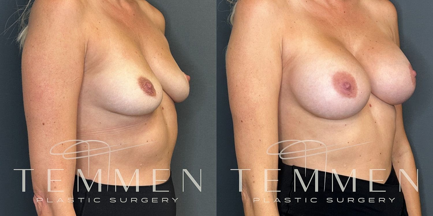 Small Breast Augmentation Before & After