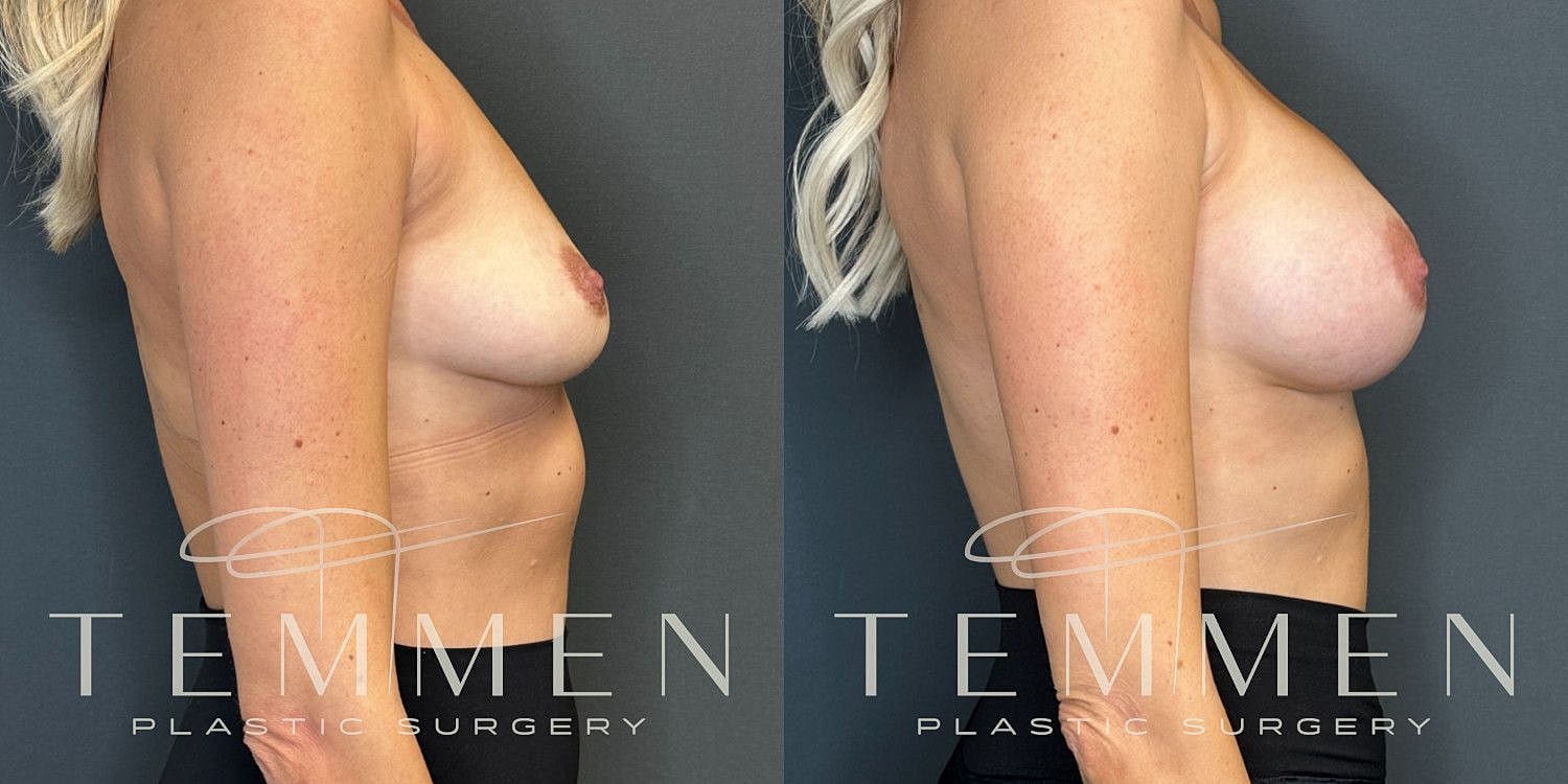 Small Breast Augmentation Before & After