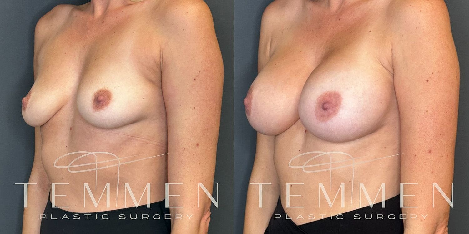 Small Breast Augmentation Before & After
