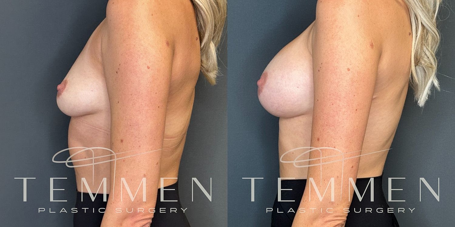 Small Breast Augmentation Before & After