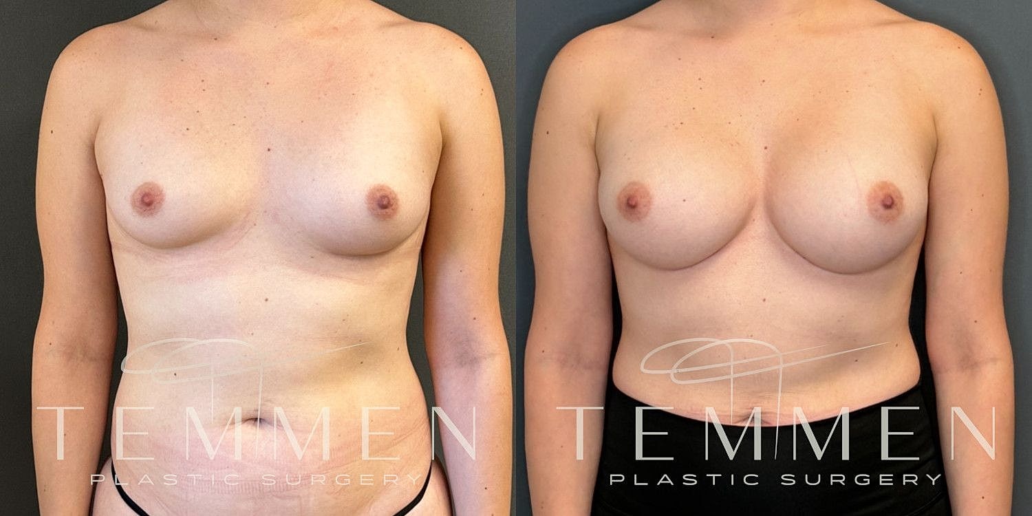Small Breast Augmentation Before & After