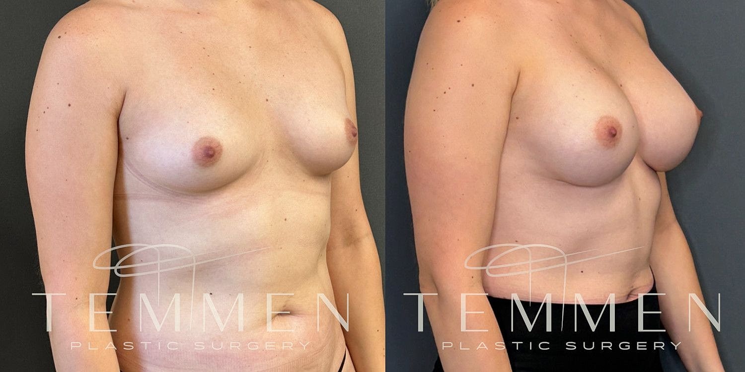 Small Breast Augmentation Before & After