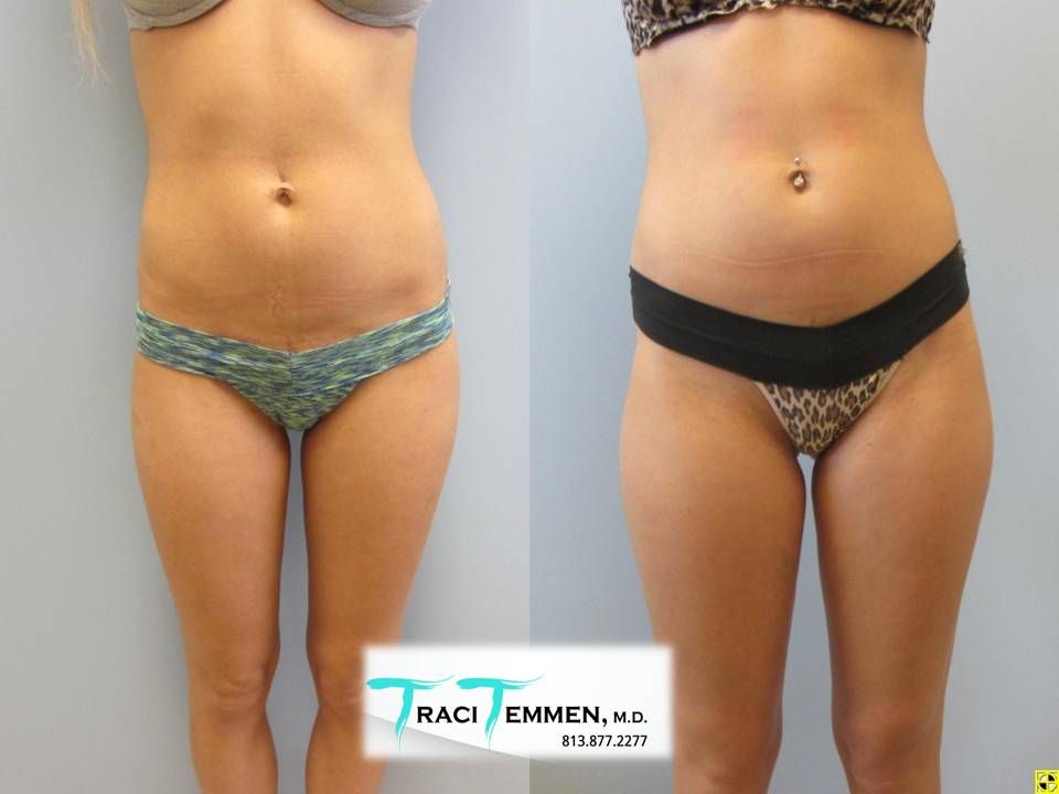 Gluteal Implants Butt Implants Before & After