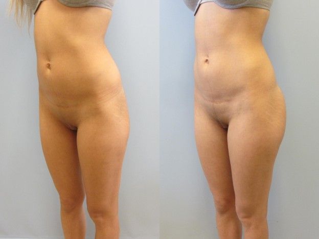 Gluteal Implants Butt Implants Before & After